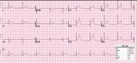 moderate high lateral repolarization disturbance